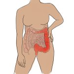 Morbus Crohn / Colitis ulcerosa