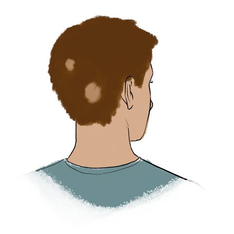 Kreisrunder Haarausfall / Alopecia Areata